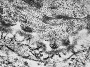 F,23y. | normal oral mucosal epithelium - hemidesmosomes and anchoring fibrils F,23y. | normal oral mucosal epithelium - hemidesmosomes and anchoring fibrils